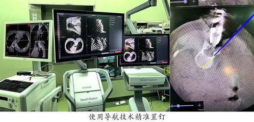 導(dǎo)航系統(tǒng)助兒童脊柱手術(shù)更精準 復(fù)旦兒科暑期手術(shù)刷新記錄